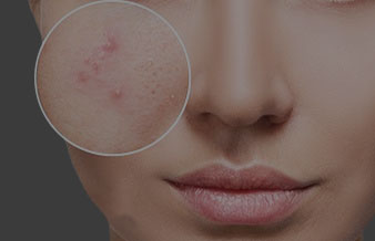 What is Acne & What are the Causes Symptoms of Acne